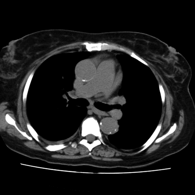 Aortic arch pseudoaneurysm (Radiopaedia 8534-9368 Axial non-contrast 33).jpg