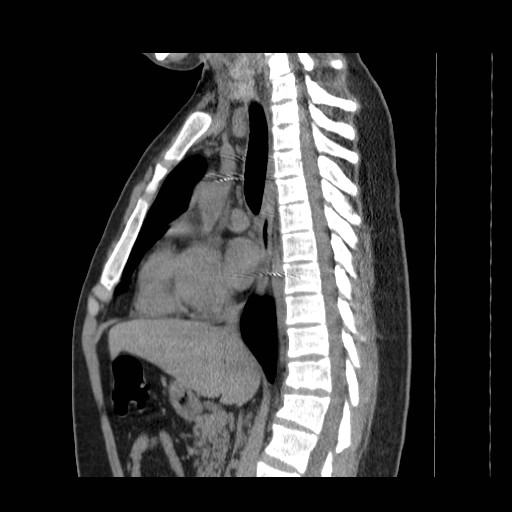 File:Aortic arch stent (Radiopaedia 30030-30595 B 7).jpg