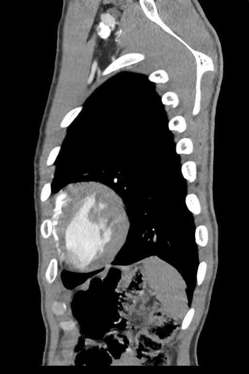 Aortic coarctation with aneurysm (Radiopaedia 74818-85828 B 136).jpg