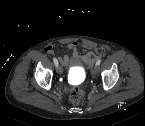 Aortic dissection (CTPA) (Radiopaedia 75506-86750 E 133).jpg