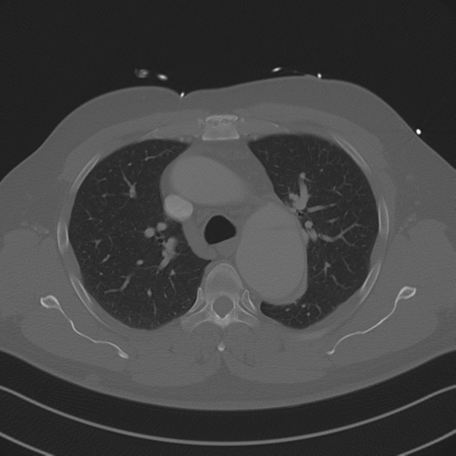 Aortic dissection (Radiopaedia 50763-56234 Axial bone window 40).png