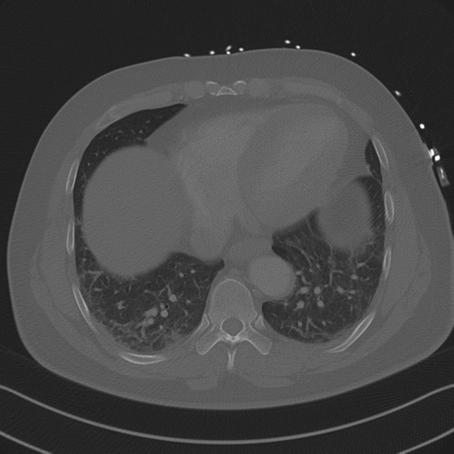 Aortic dissection (Radiopaedia 50763-56234 Axial bone window 75).png