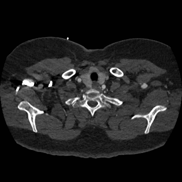 Aortic dissection (Radiopaedia 57969-64959 A 25).jpg