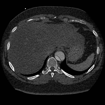 File:Aortic dissection (Radiopaedia 57969-64959 A 264).jpg