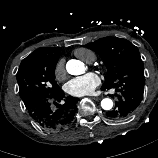 File:Aortic dissection - DeBakey type II (Radiopaedia 64302-73082 A 52).png
