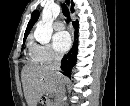 Aortic dissection - Stanford A -DeBakey I (Radiopaedia 28339-28587 C 17).jpg