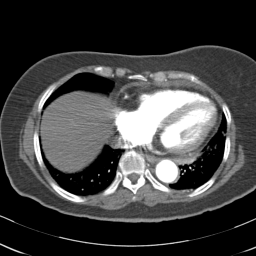 File:Aortic dissection - Stanford type A (Radiopaedia 39073-41259 A 56).png