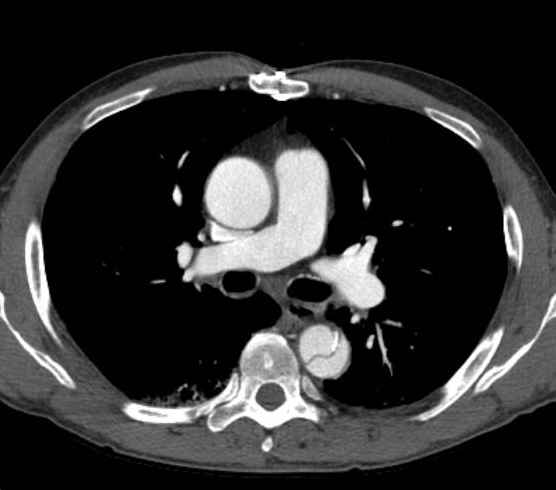 Aortic dissection - Stanford type B (Radiopaedia 73648-84437 A 44).jpg