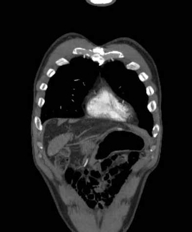 Aortic dissection - Stanford type B (Radiopaedia 73648-84437 B 20).jpg