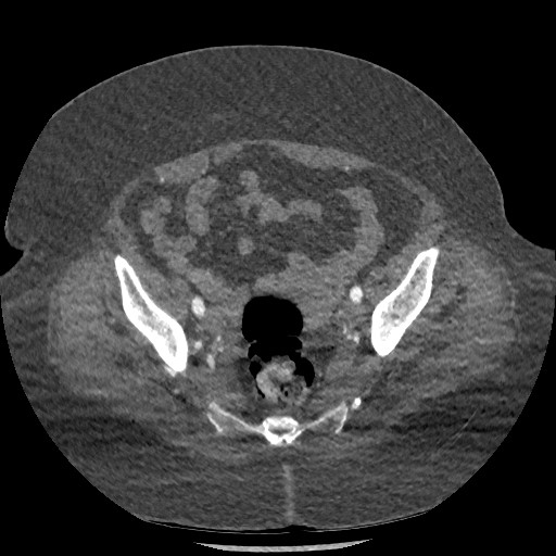 Aortic dissection - Stanford type B (Radiopaedia 88281-104910 A 148).jpg