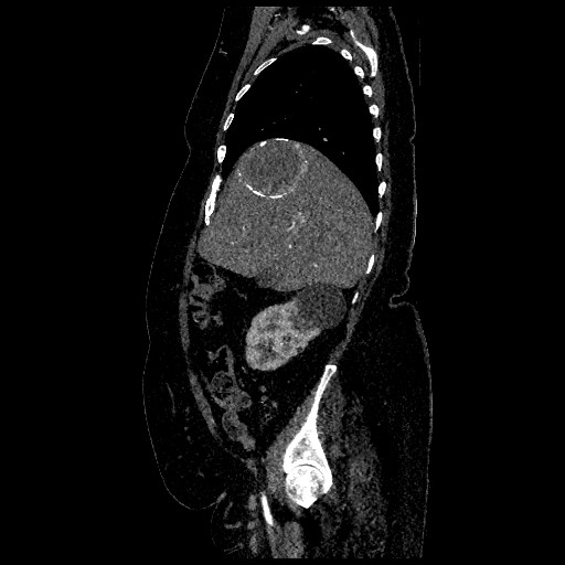 File:Aortic dissection - Stanford type B (Radiopaedia 88281-104910 C 17).jpg
