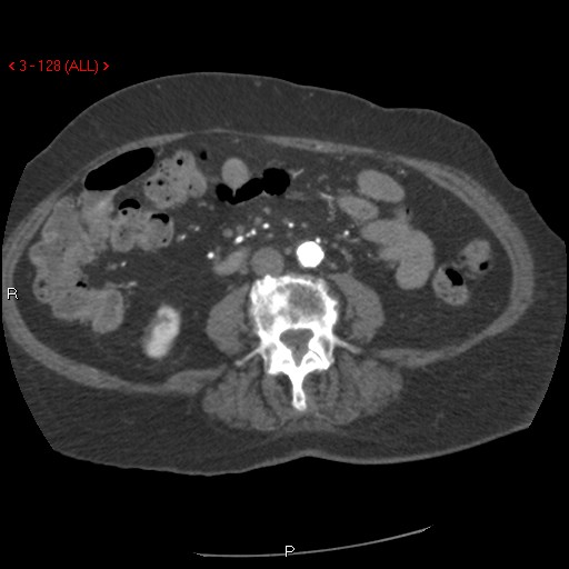 Aortic intramural hematoma (Radiopaedia 27746-28001 A 128).jpg