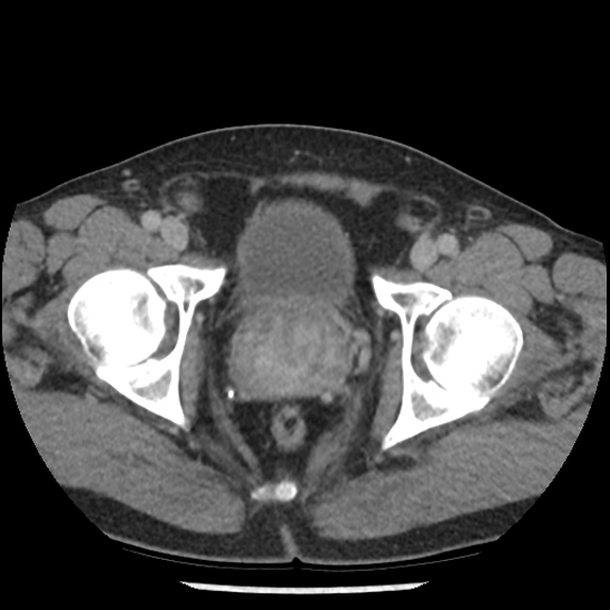 Aortic intramural hematoma (type B) (Radiopaedia 79323-92387 Axial C+ delayed 111).jpg