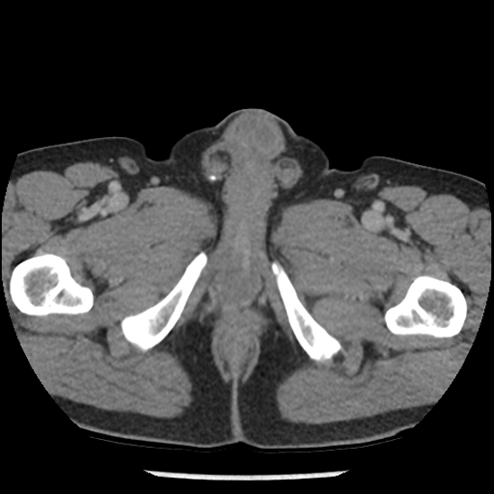 Aortic intramural hematoma (type B) (Radiopaedia 79323-92387 Axial C+ delayed 124).jpg