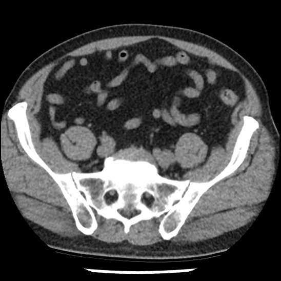 File:Aortic intramural hematoma (type B) (Radiopaedia 79323-92387 Axial non-contrast 93).jpg