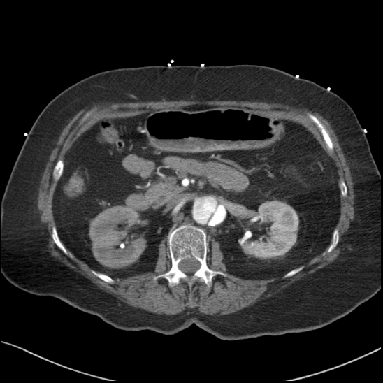 Aortic intramural hematoma with dissection and intramural blood pool (Radiopaedia 77373-89491 B 124).jpg