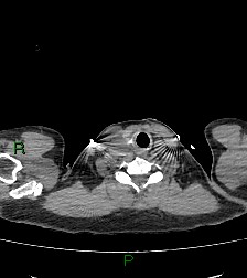 Aortic valve endocarditis (Radiopaedia 87209-103485 Axial non-contrast 2).jpg