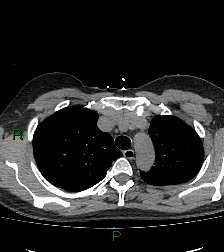 Aortic valve endocarditis (Radiopaedia 87209-103485 Axial non-contrast 27).jpg