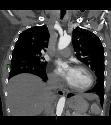 Aortic valve endocarditis (Radiopaedia 87209-103485 D 38).jpg