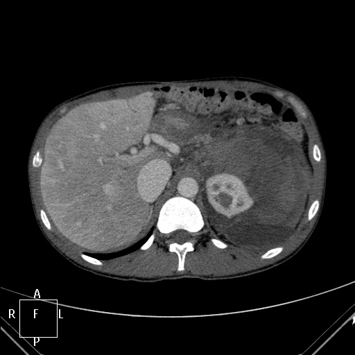 File:Aorto-left renal vein fistula (Radiopaedia 45534-49628 A 4).jpg
