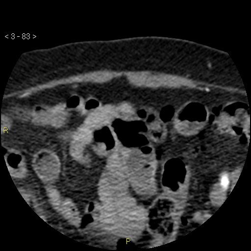 Aortoiliac occlusive disease (Radiopaedia 16828-16548 A 83).jpg