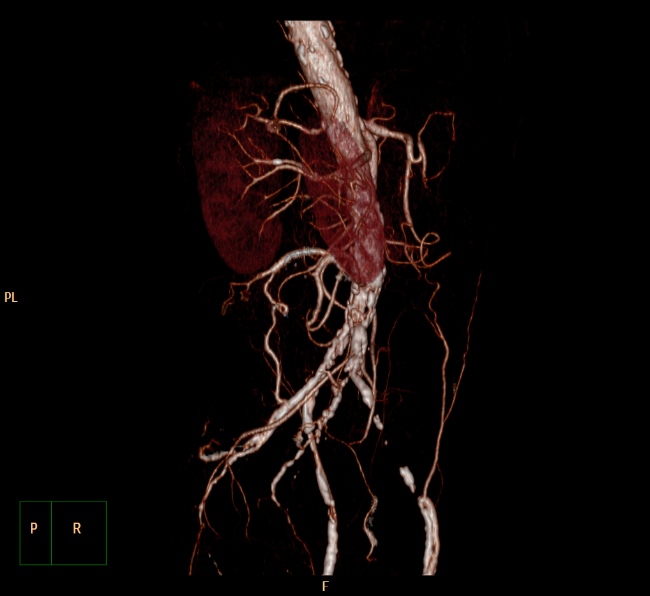 File:Aortoiliac occlusive disease (Radiopaedia 32134-33076 VR C+ arterial phase 6).jpg
