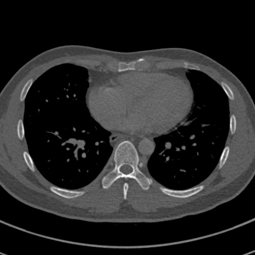 File:Apical lung mass mimic - neurogenic tumor (Radiopaedia 59918-67521 Axial bone window 53).jpg