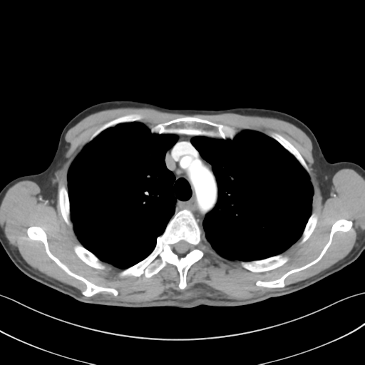Apical pleural calcification (Radiopaedia 46141-50499 Axial C+ delayed 19).png