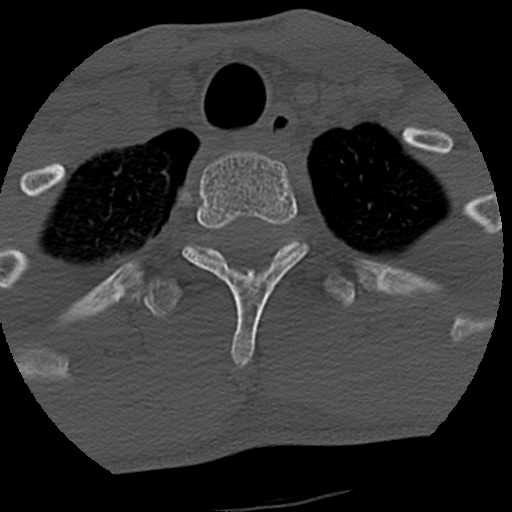 File:Apical pneumothorax on cervical spine CT (Radiopaedia 45343-49368 Axial bone window 89).jpg