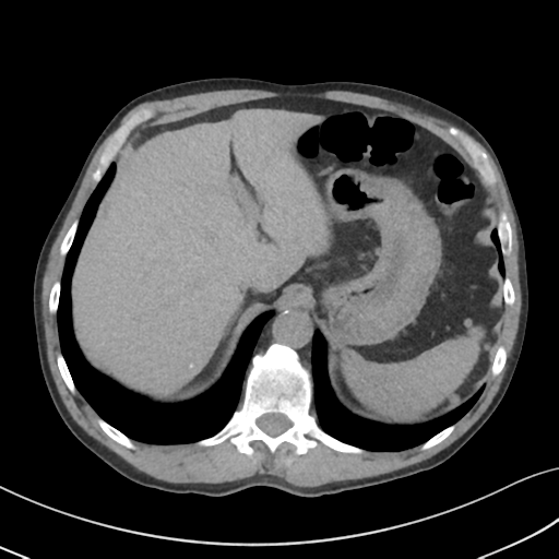File:Apical pulmonary metastasis (Radiopaedia 46338-50754 B 58).png