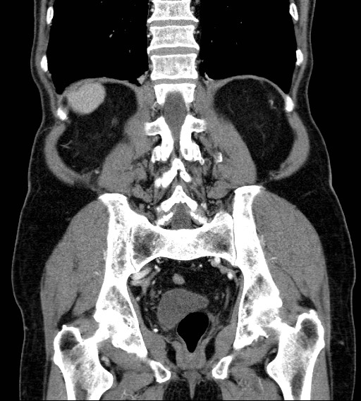 File:Appendiceal adenocarcinoma complicated by retroperitoneal abscess (Radiopaedia 58007-65039 A 65).jpg