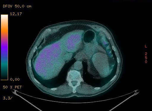 Appendiceal adenocarcinoma complicated by retroperitoneal abscess (Radiopaedia 58007-65041 Axial PET-CT 102).jpg