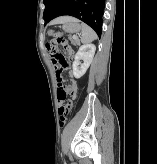 Appendiceal mucinous adenocarcinoma (Radiopaedia 66605-75922 C 53).jpg