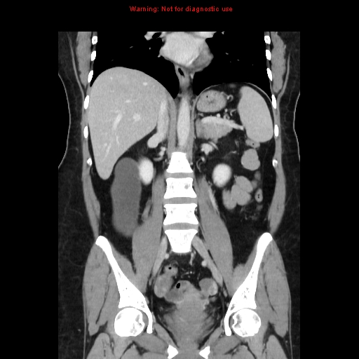 Appendiceal mucinous cystadenoma (Radiopaedia 8263-9111 B 42).jpg
