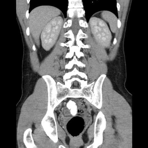 File:Appendicitis complicated by post-operative collection (Radiopaedia 35595-37113 B 40).jpg