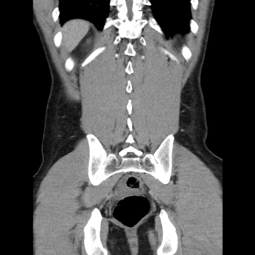 File:Appendicitis complicated by post-operative collection (Radiopaedia 35595-37113 B 44).jpg