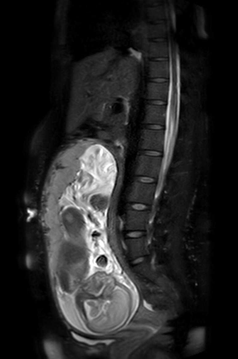 Appendicitis in gravida (MRI) (Radiopaedia 89433-106395 Sagittal T2 SPAIR 30).jpg