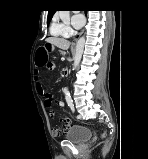 Appendicitis with localized perforation and abscess formation (Radiopaedia 49035-54130 C 35).jpg
