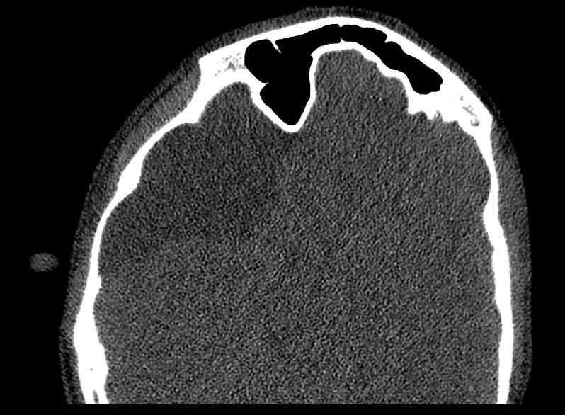 Arachnoid cyst- extremely large (Radiopaedia 68741-78450 Axial bone window 43).jpg