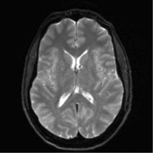 Arachnoid cyst - cerebellopontine angle (Radiopaedia 59689-67083 Axial DWI 20).png