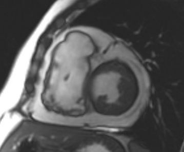 File:Arrhythmogenic right ventricular cardiomyopathy (Radiopaedia 69431-79307 Short axis cine 130).jpg