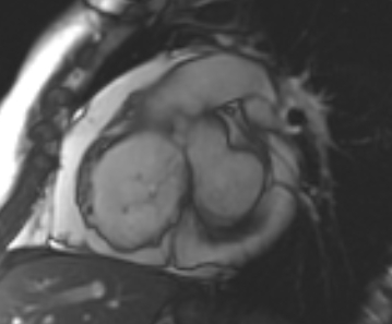File:Arrhythmogenic right ventricular cardiomyopathy (Radiopaedia 69431-79307 Short axis cine 189).jpg