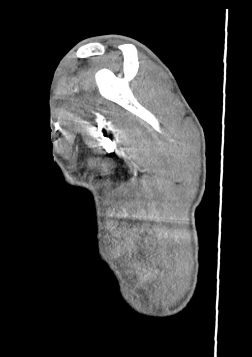 Arrow injury in the neck (Radiopaedia 75268-86390 G 20).jpg