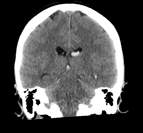 File:Arteriovenous malformation (cerebral) (Radiopaedia 40070-42579 Coronal non-contrast 23).png