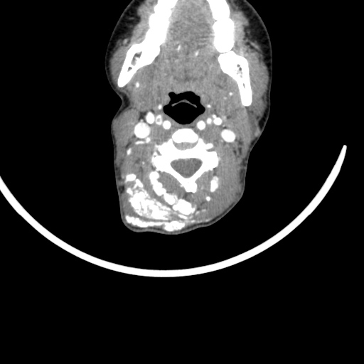 Arteriovenous malformation of the neck (Radiopaedia 53935-60062 A 38).jpg