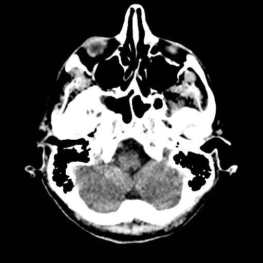 File:Artery of Percheron infarct (Radiopaedia 48088-52893 Axial non-contrast 5).jpg
