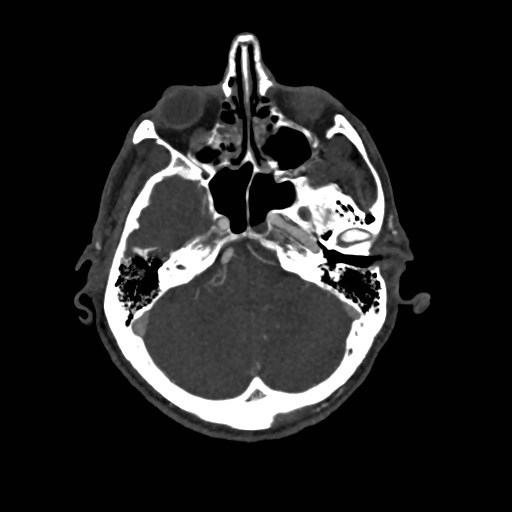 File:Artery of Percheron infarct (Radiopaedia 48088-52894 A 116).jpg