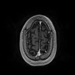 File:Artery of Percheron infarction (Radiopaedia 27975-28230 Axial T1 C+ fat sat 89).jpg