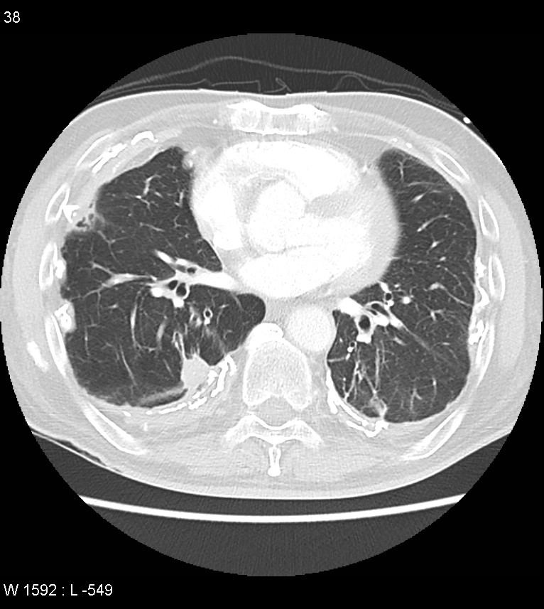Asbestos related lung and pleural disease (Radiopaedia 14377-14301 A 35).jpg