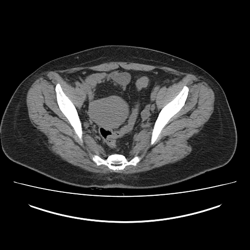 Ascending retrocecal appendicitis with liver abscesses (Radiopaedia 60066-67615 Axial non-contrast 73).jpg
